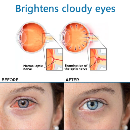 Eye drops for treating vision issues